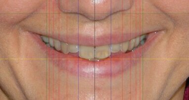 Projektowanie uśmiechu na podstawie zdjęcia twarzy