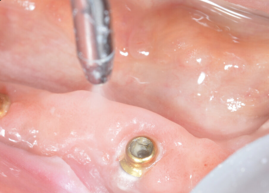 Fig. 6_Manovre di rimozione del biofilm batterico su OT Equator.