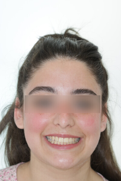 Fig. 21: Final situation after 25 Reveal aligners.