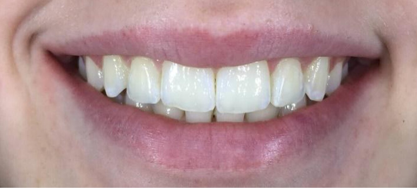 Fig. 17: Close-up view of the patient’s smile after aligner treatment.