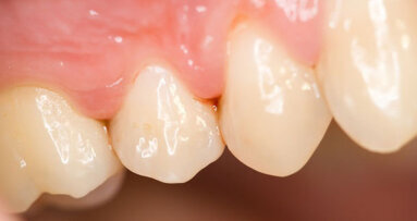 Patiënten met tandplaque overlijden eerder door kanker