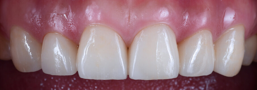 Fig. 13: IPS e.max Press Multi restorations immediately after placement