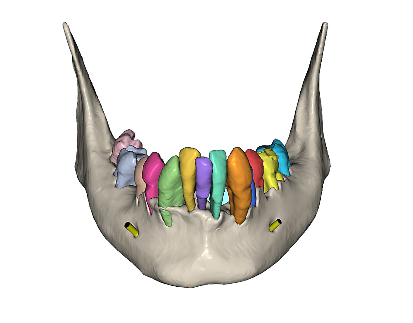 Fig. 13a: Fully segmented mandibular bone and teeth.