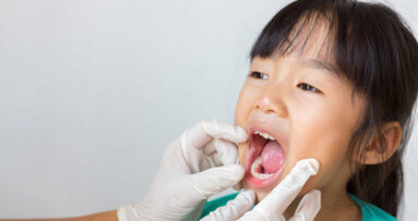 Lakowanie trzonowców zmniejsza ryzyko próchnicy