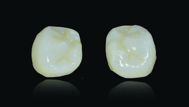 Restoring implants using lithium-disilicate,CAD/CAM fabricated restorations