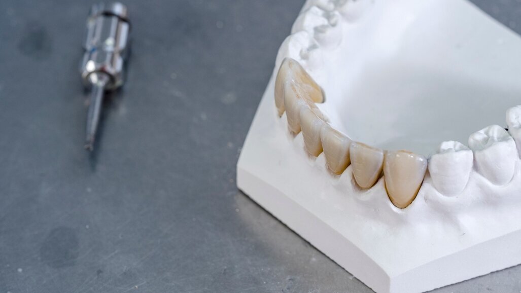 Monolithique zircone : la prothèse de précision pour vos patients