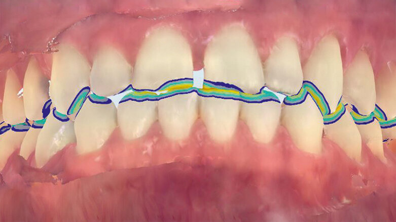 Smile Makeover pomocí fóliového ortodontického aparátu a kompozitních dostaveb