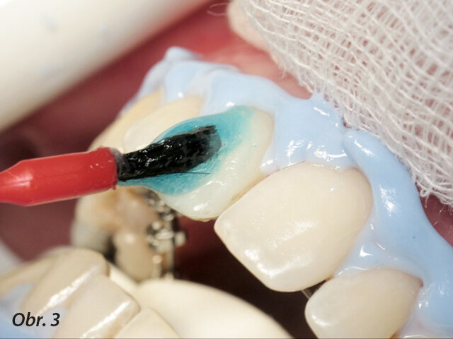 Obr. 3: Aplikace bělicího gelu na vestibulární plošky zubů.