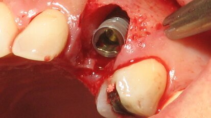 Imedijatna ugradnja implantata u estetskoj zoni