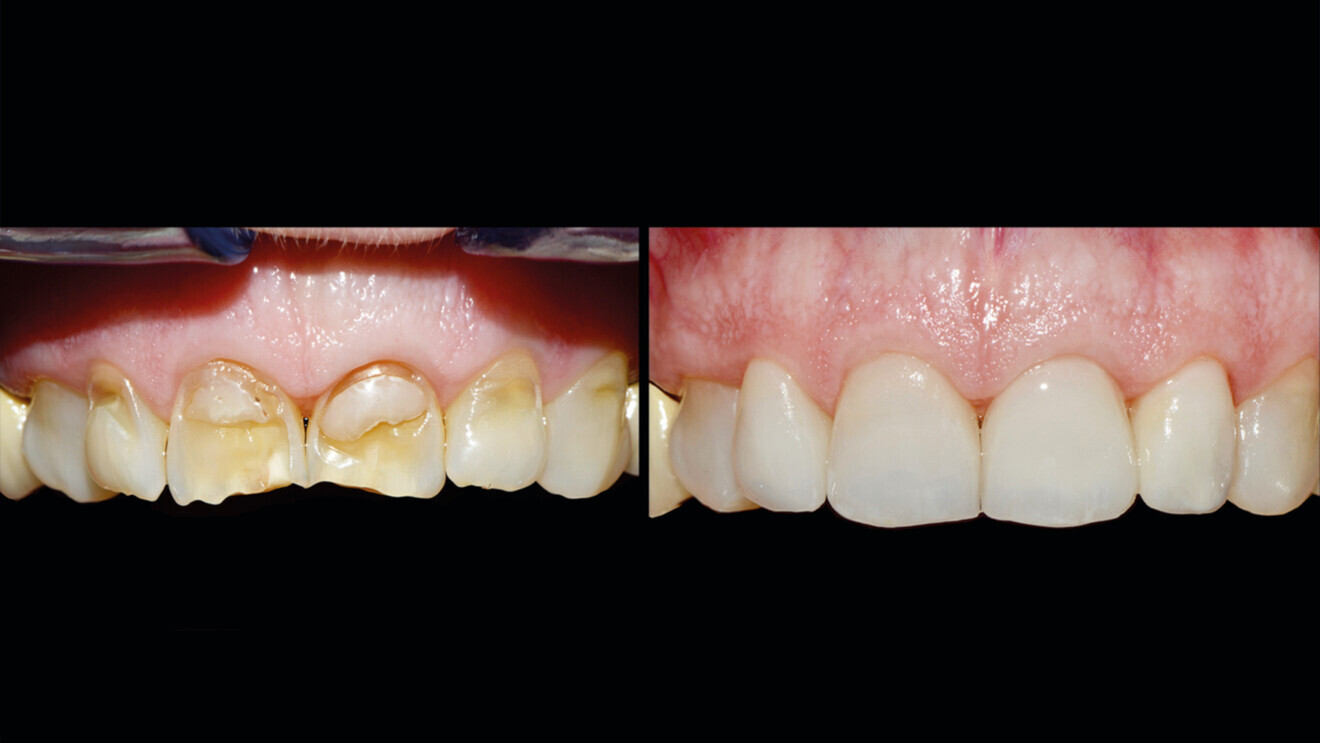 The CAD/CAM BLOCK has the optical properties of natural enamel, giving the restorations made from it a lifelike appearance.
