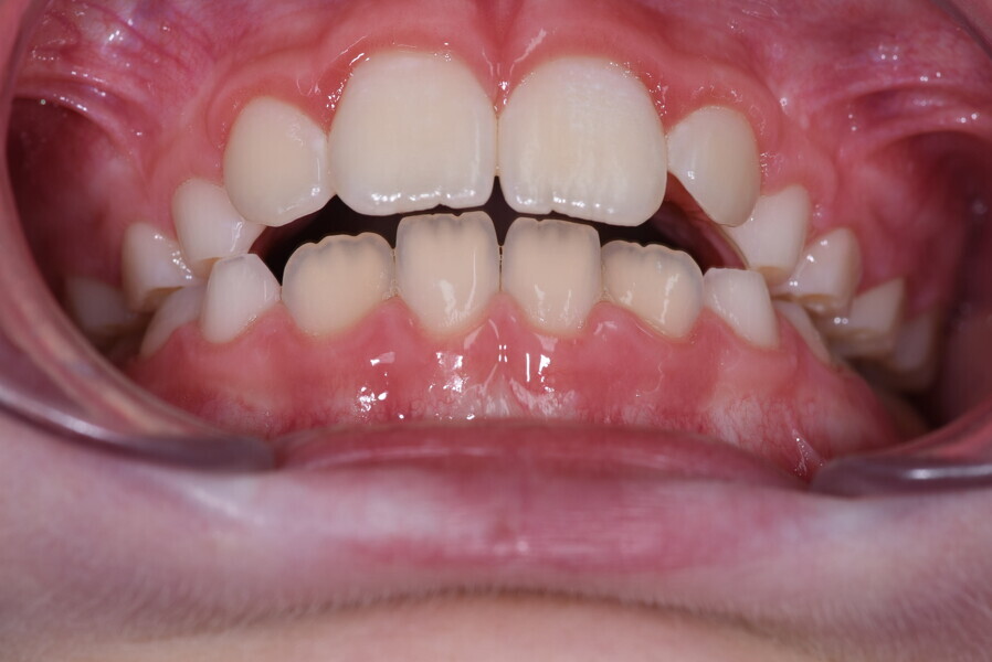 Figs. 1a–d: Open bite due to the tongue interposition from childhood into adulthood.