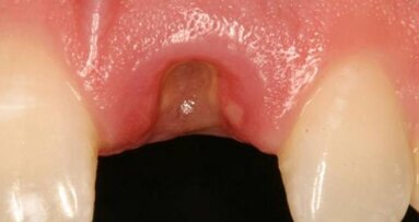 Gestion d'un implant unitaire, dans la zone esthétique