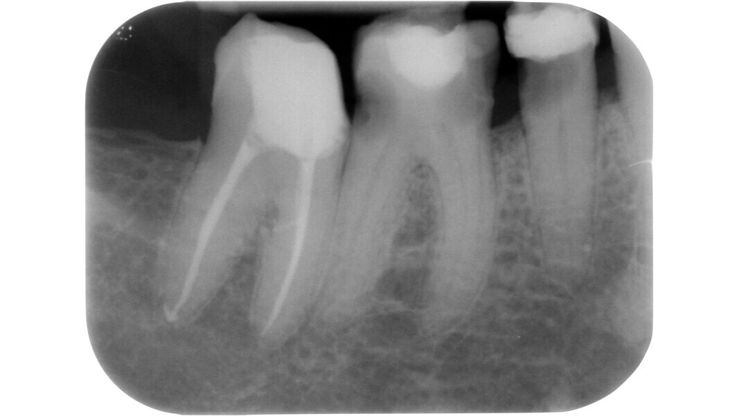 Fig. 8: Pre-op radiograph showing severe carious processes affecting teeth #45 and 46.