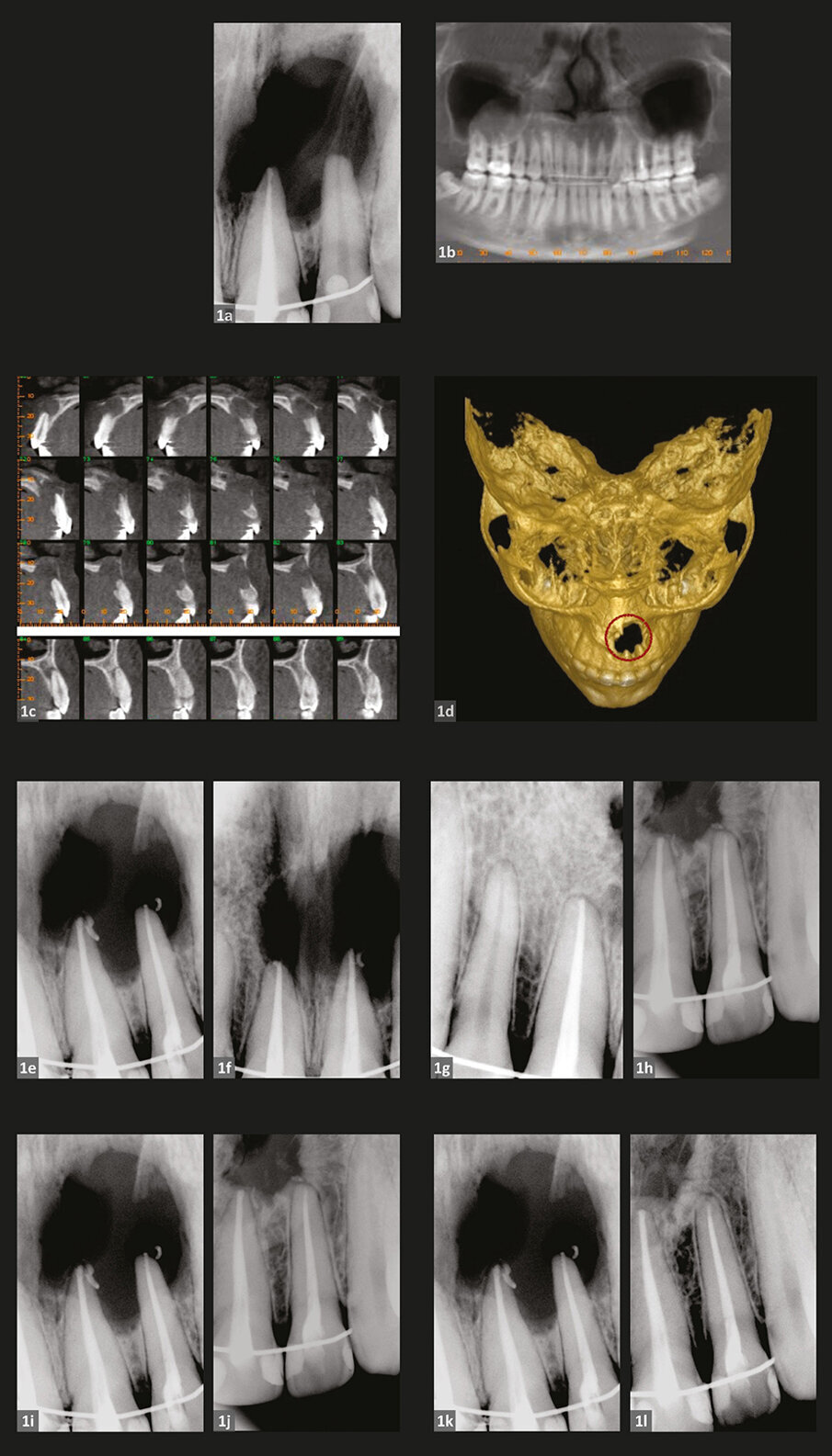 SLUČAJ 1
Slike 1a i 1b: Preoperativni periapikalna (a) i panoramska radiografija (b).
Slika 1c: CBCT aksijalni rezovi.
Slika 1d: CBCT 3-D rekonstrukcija pokazuje obim lezija(e).
Slike 1e i 1f: Postoperativne radiografije neposredno nakon tretmana levih (e) i centralnih sekutića (f)
Slike 1g i 1h: Jednogodišnje praćenje.
Slike 1i i 1j: Poređenje postoperativne radiografije (i) sa situacijom nakon godinu dana (j)
Slike 1k i 1l: Poređenje postoperativne radiografije (k) sa 5-godišnjim praćenjem (l)
