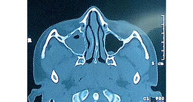 Patologías del seno maxilar