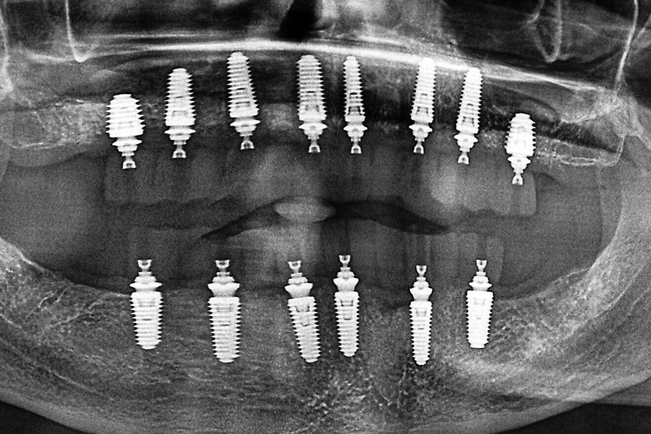 Fig. 16a: Panoramic radiograph showing printed restorations secured with Grammetry Vortex LA VIS screws.