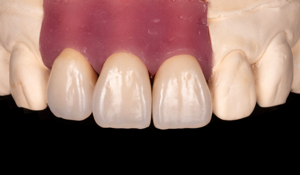 Fig. 8: Frontal view of the crowns on the model, showing the natural surface texture obtained.