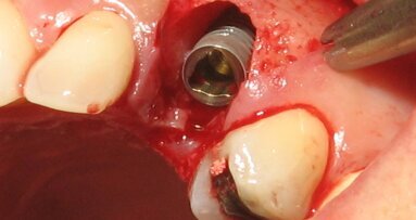 Imedijatna ugradnja implantata u estetskoj zoni