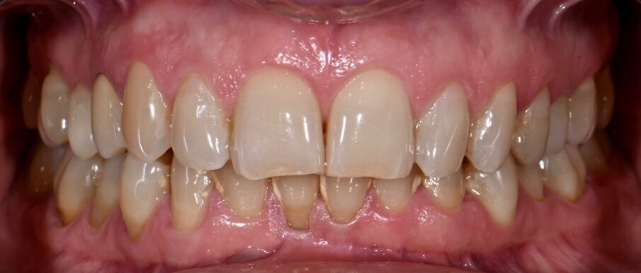 Fig. 1a - Condizione clinica al baseline: visione frontale.