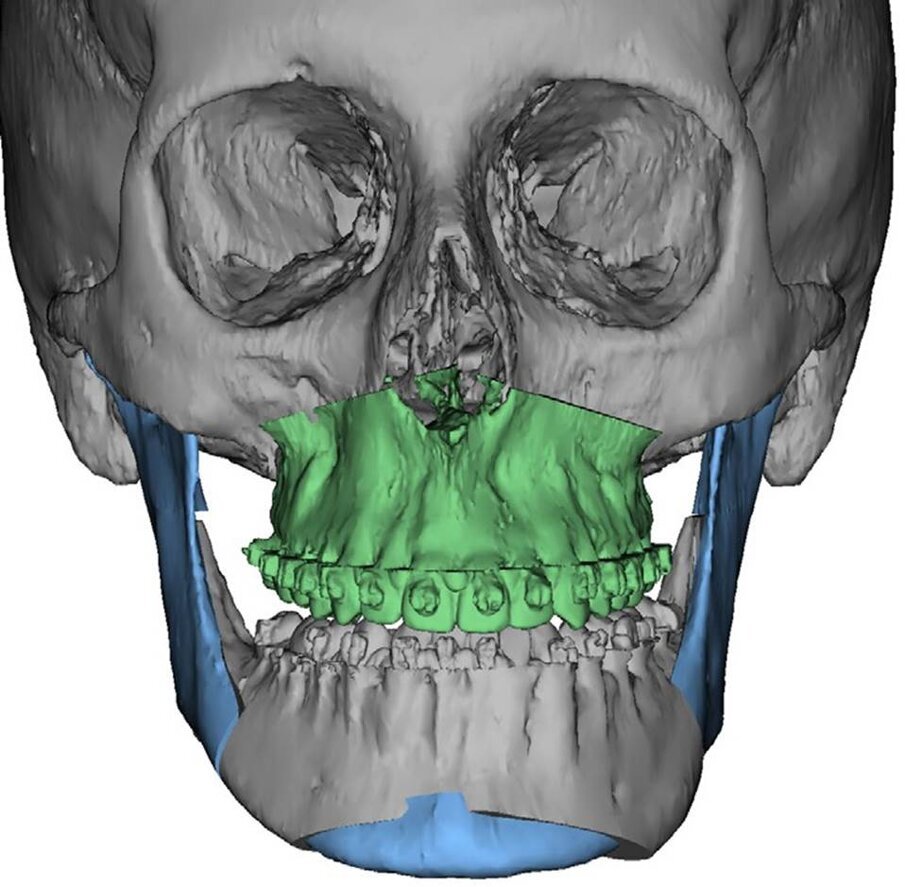 Fig. 4_Programmazione chirurgica.