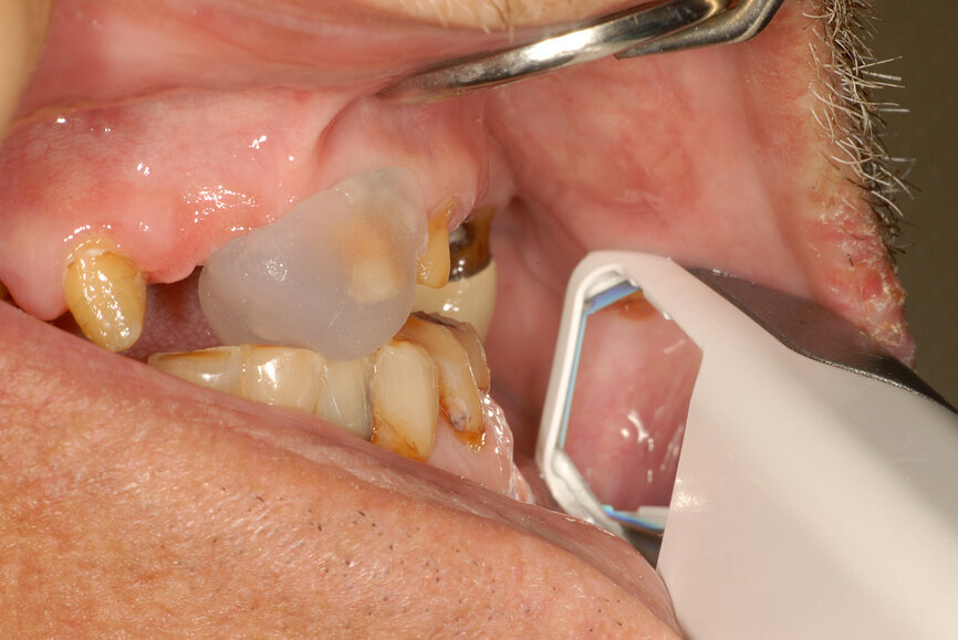 Fig. 26: Digital recording of centric relation using a conventional finding method with a composite device at the desired vertical dimension of occlusion.
