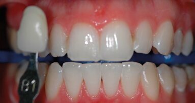 Valutazione clinica degli agenti sbiancanti professionali al 6% e al 25% di perossido di idrogeno su denti vitali