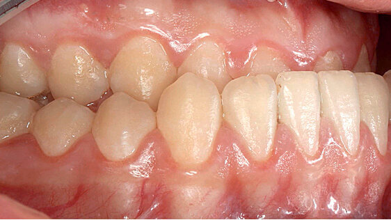 Komplexní ortodonticko-chirurgické ošetření funkčně estetické vady