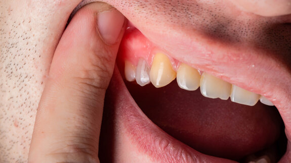 Wearable oral biosensor detects inflammation in real time