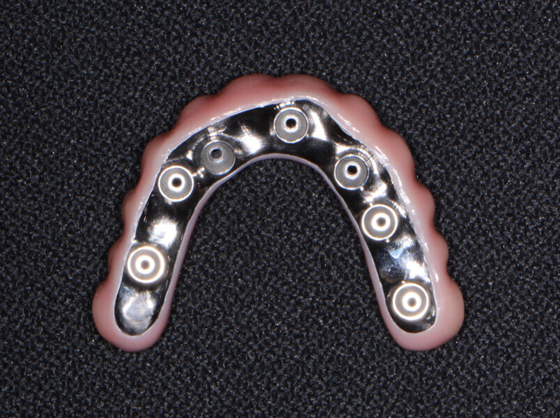 Fig. 16: Monolithic hybrid restoration with the titanium frame shown.