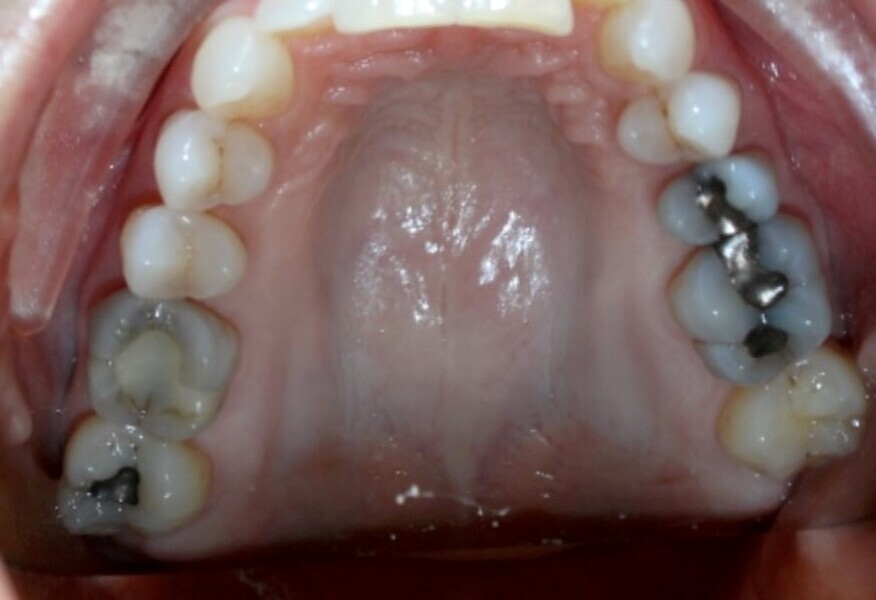 Fig. 18b: Class II malocclusion requiring fixed appliance treatment. (a) Lateral view. (b) Occlusal view.