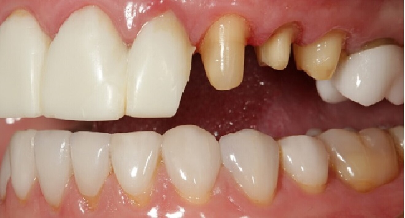 Fig. 7: Situation after removal of the provisional restorations on the maxillary left side prior to placement of the PMMA prototype restorations.