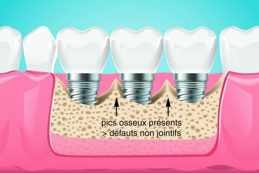 Fig. 3 : PA3a : Perte osseuse < 50 % de la hauteur sur des implants adjacents séparés de plus de 3 mm, avec ou sans cratère. 