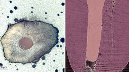 טיפולי שורש: מיקרו סדקים הם לא תוצאה של הליכים מכאניים