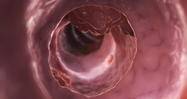 Une bactérie orale peut contribuer au cancer colorectal