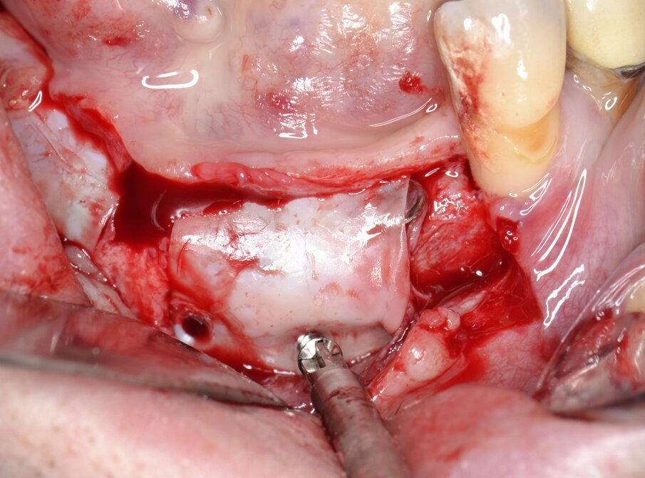 Fig. 12 - Al termine di un adeguato periodo di guarigione la membrana in PTFE viene rimossa.