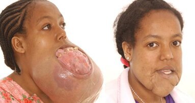 Neues Gesicht: Ärzte entfernen Riesen-Tumor