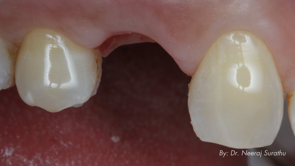 Fig. 12: Three-month post-op image showing healthy tissue with intact papillae, enabling accurate replication of the tissue profile for the definitive restoration.