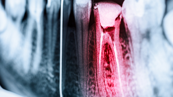 Wirtschaft und Stress führen zu schlechten Wurzelfüllungen