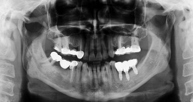 Guided bone regeneration around one-stage nonsubmerged dental implants with bone defects