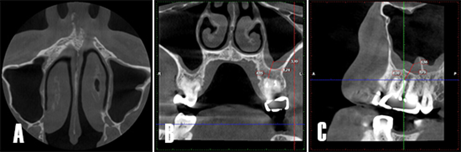 Figura 8. Control tomogrÃ¡fico a los 12 meses. A) Corte en el plano axial: se observa la cavidad sinusal sin opacificaciÃ³n. B) Corte coronal: se observa la cavidad sinusal limpia, la zona apical se observa mÃ¡s radiodensa, lo que sugiere la formaciÃ³n de hueso nuevo. C) Corte sagital: se aprecia cÃ³mo el engrosamiento de la membrana se asocia a la presencia del septo Ã³seo del seno maxilar.