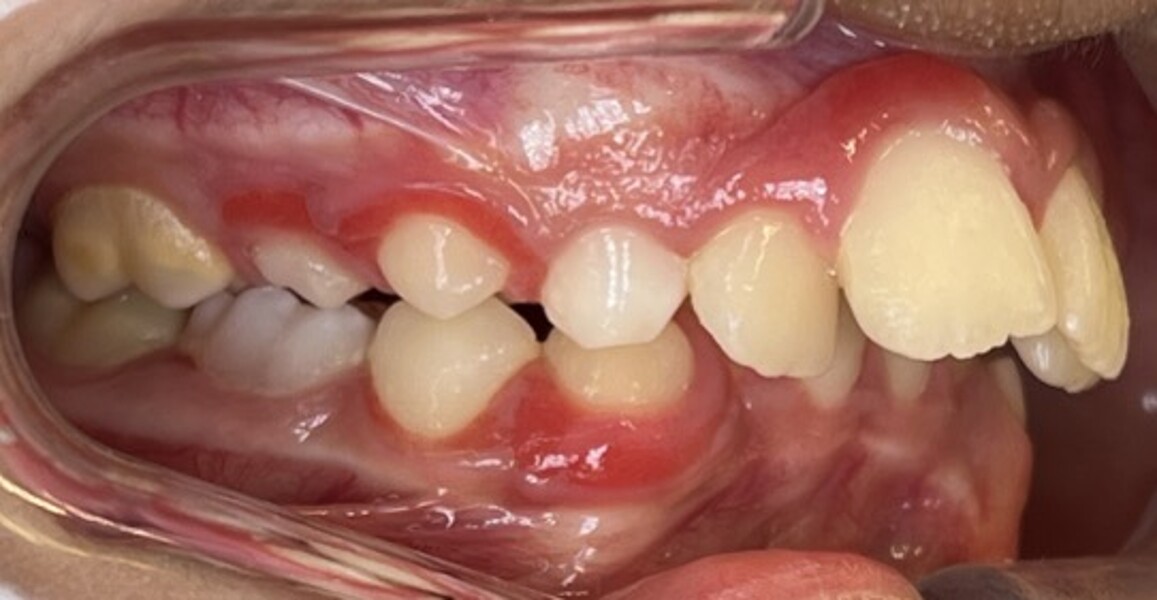 Figs. 2a–e: Pretreatment intra-oral photographs.