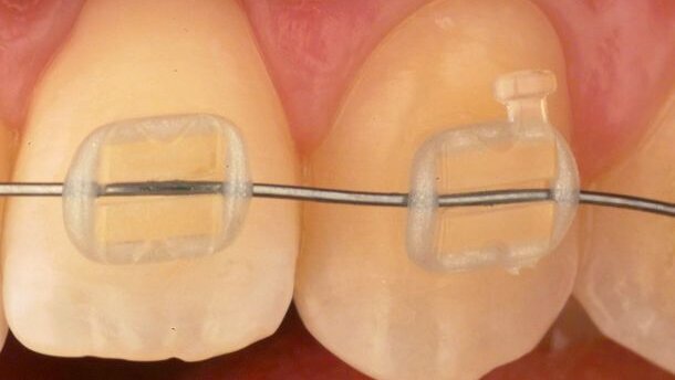 Des chercheurs espagnols développent une nouvelle génération de brackets invisibles