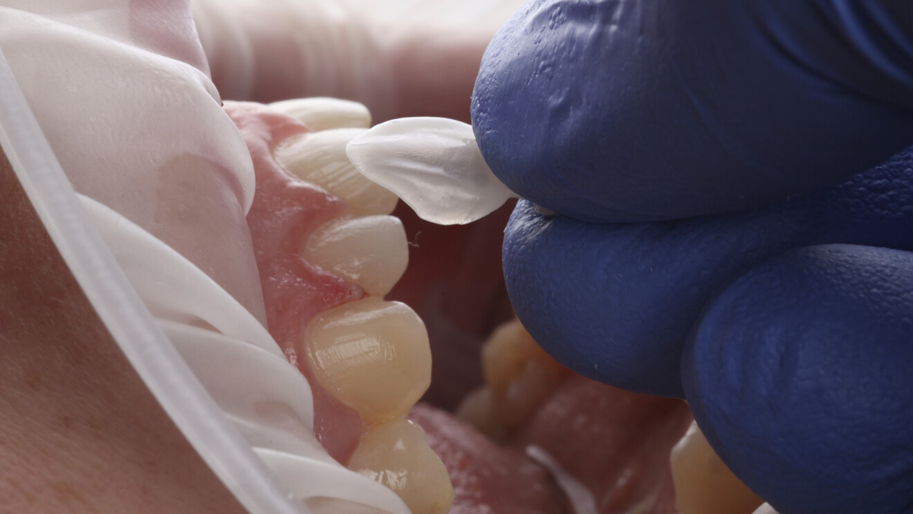Figs. 5a–c: Clinical try-in of the printed veneers to assess fit, emergence profile, proximal contacts and overall morphology before adhesive cementation.