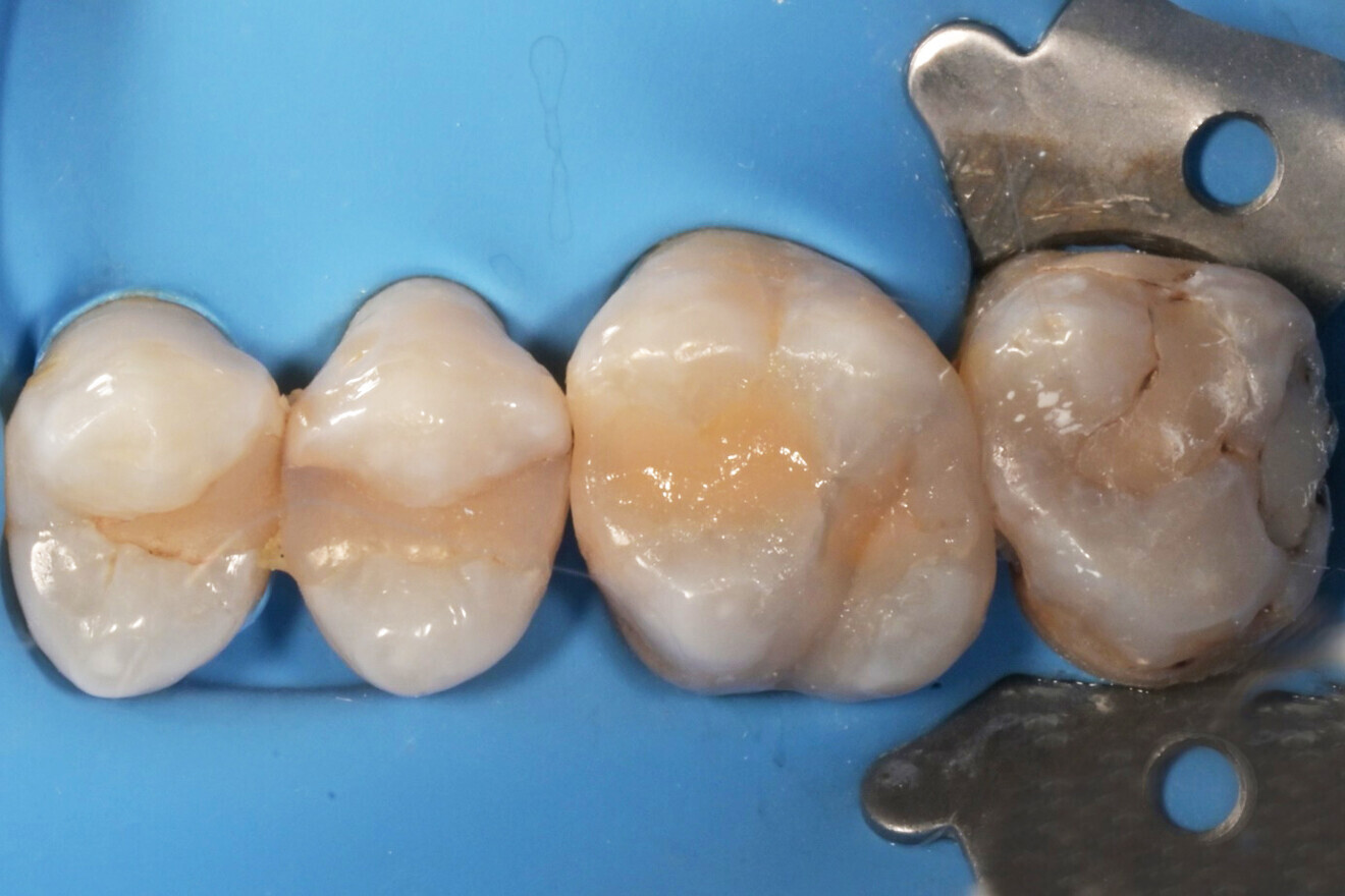 Фиг. 10: Зъбът след нанасяне на един слой A3B универсален композит. 