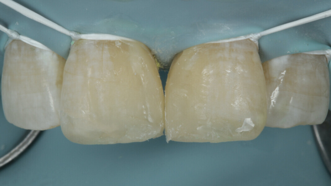 Fig 16. Contact point is achieved at the desired level The main body is built with blending the A3.5 and A3 Body shades.