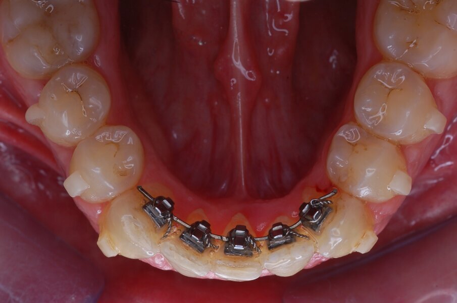 Figg. 37-44_Fotografie intraorali in sequenza che illustrano il progressivo allineamento dell’arco mandibolare.