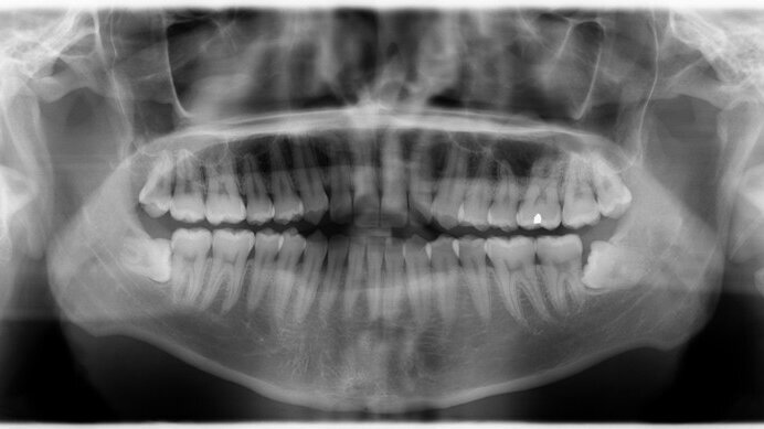 Ακτινογραφίες και καρκίνος του θυρεοειδή