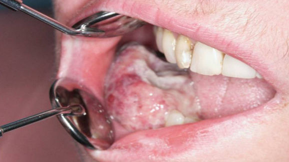 Идентифицирана е причината за разпространението на оралния карцином