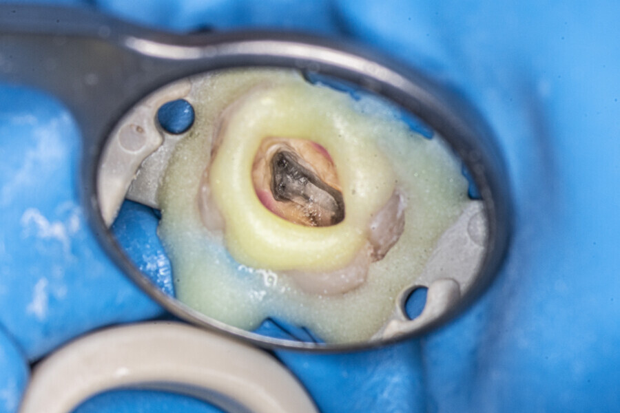 Fig. 55: Buccal side of the pulp chamber once the calcification had been removed. The orifices were visible but not yet patent.