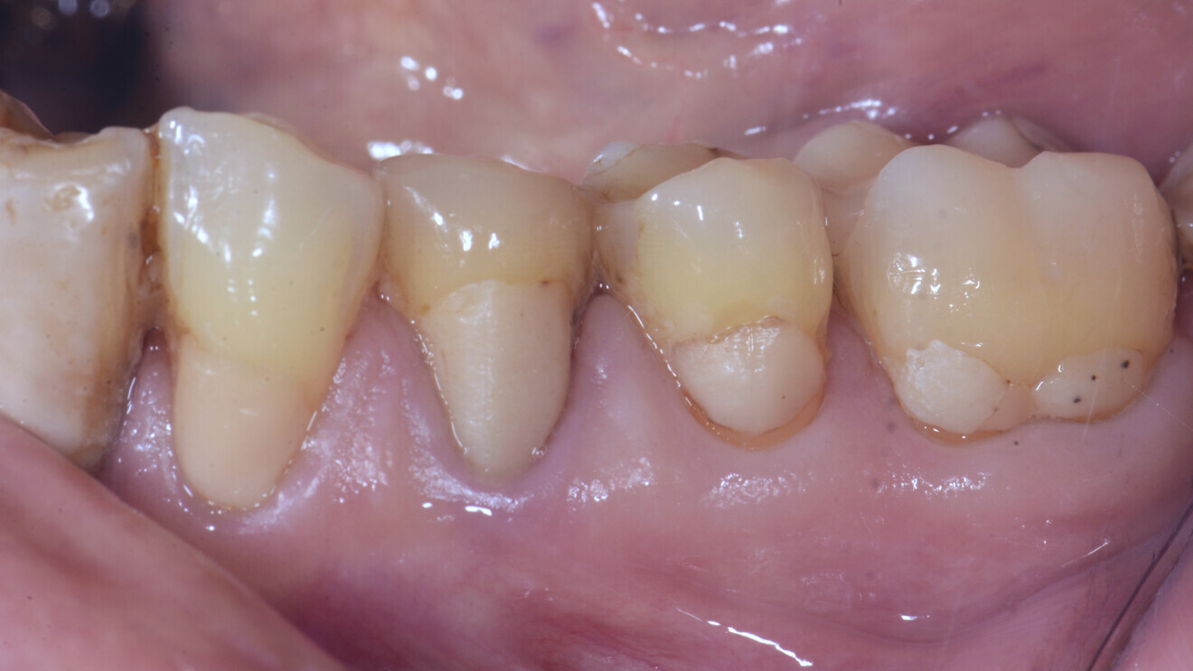 Fig. 4ac: Même restauration après 6,5 ans (Avec l’aimable autorisation du Pr M. Basso, Italie).